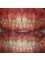 Silver Oaks Dental Clinic - Crown lengthening and dental veneers in Durban  