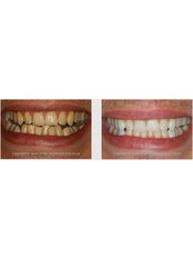 Teeth Cleaning - Silver Oaks Dental Clinic