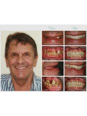 Restoration of Implants - Silver Oaks Dental Clinic