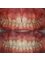 Silver Oaks Dental Clinic - dental veneers  