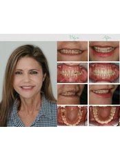 Porcelain Crown - Silver Oaks Dental Clinic