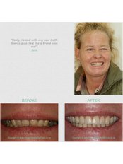 Dental Bonding - Silver Oaks Dental Clinic