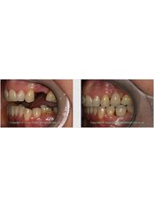Implant Bridge - Silver Oaks Dental Clinic