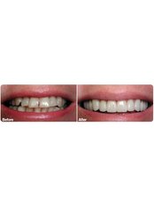CEREC Dental Restorations - Silver Oaks Dental Clinic