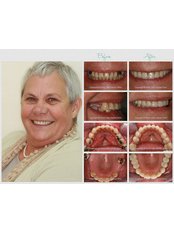 Dental Implants, Crowns and Veneers  - Silver Oaks Dental Clinic