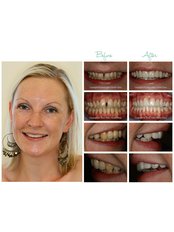 Veneers - Silver Oaks Dental Clinic
