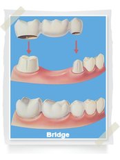 Permanent Bridge - Big Red Tooth Dental Practice