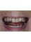 Dr. Adé Meyer Cosmetic Dentistry - Stained teeth and old crowns - Before 