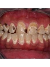 CAD/CAM Dental Restorations - Dr. Adé Meyer Cosmetic Dentistry