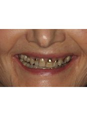 Porcelain Crown - Dr. Adé Meyer Cosmetic Dentistry