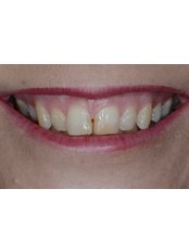 Veneers - Dr. Adé Meyer Cosmetic Dentistry