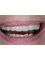 Dr. Adé Meyer Cosmetic Dentistry - Replacing old crowns with Cerec in one appointment 