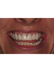 Dental Crowns - Dr. Adé Meyer Cosmetic Dentistry