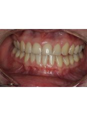 Zoom! Teeth Whitening - Dr. Adé Meyer Cosmetic Dentistry