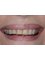 Dr. Adé Meyer Cosmetic Dentistry - Grinded down teeth and old gold - Before 