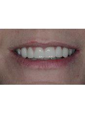 Porcelain Veneers - Dr. Adé Meyer Cosmetic Dentistry