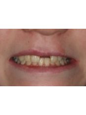 CEREC Dental Restorations - Dr. Adé Meyer Cosmetic Dentistry
