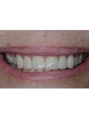 Veneers - Dr. Adé Meyer Cosmetic Dentistry