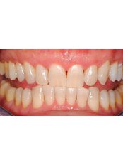 Teeth Whitening - WowTeeth