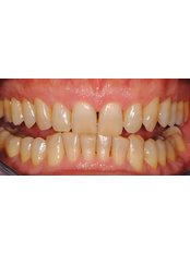 Teeth Whitening - WowTeeth