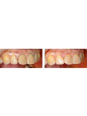 Composite Veneers - Blanche Hyung Dental