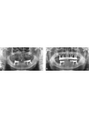 Dental Implants - Blanche Hyung Dental