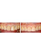 Composite Veneers - Blanche Hyung Dental
