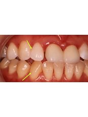 Teeth Whitening - Blanche Hyung Dental