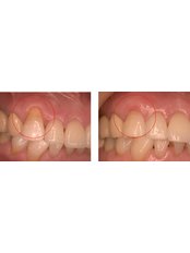 GTR - Guided Tissue Regeneration - Blanche Hyung Dental