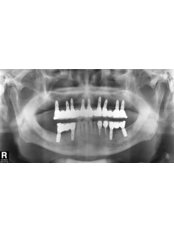 Digital Panoramic Dental X-Ray - Blanche Hyung Dental