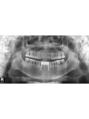 Digital Dental X-Ray - Blanche Hyung Dental