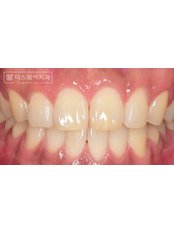 Clear Aligner (Removable Braces) - The Square Dental Clinic