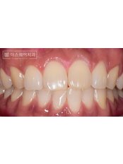 Clear Aligner (Removable Braces) - The Square Dental Clinic