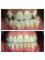 Centro Clínico de Especialidades Odontológicas - ORTHODONTICS  24 month saphire (transparent) bracket treatment 