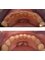 Centro Clínico de Especialidades Odontológicas - DENTAL EROSION - As time passes, teeth wear out.  The loss of tooth enamel can be restores with Composite material, giving the patient healthy, functional normal teeth. 