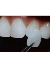 Veneers - Abaden Dental Group