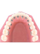 Lingual Braces - Abaden Dental Group