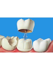 Dental Crowns - Abaden Dental Group