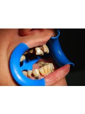 Implant Dentist Consultation - Disseny de Somriures