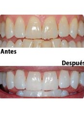 Teeth Whitening - Hident