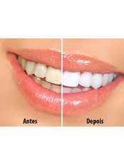 Teeth Whitening - Adent Madrid