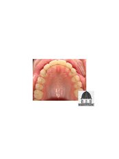 Orthodontic Retainer - Bordon Clinic
