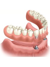 Dentures - Centro Dental Cotignola