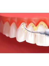 Teeth Cleaning - Centro Dental Cotignola