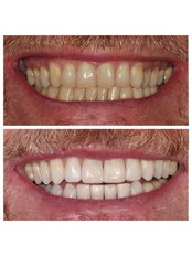 Teeth Whitening - Clínica Dental Bernabeu