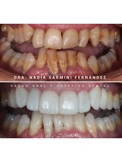 Composite Veneers - Clínica Dental Bernabeu
