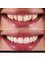 Clínica Dental Bernabeu - Before and after porcelain veneers 