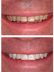 Teeth Whitening - Smilelife - Madrid