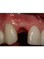Dental Implants - Dental Marbella