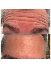 Treatment for Wrinkles - Team Kroh Dental & Facial Aesthetics
